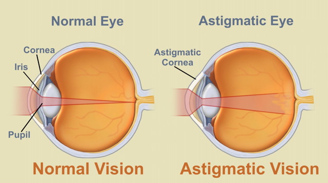 poate miopia duce la orbire
